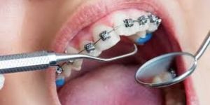 Orthodontics Treatment Services