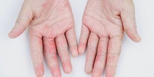 Fungal Infections Treatment