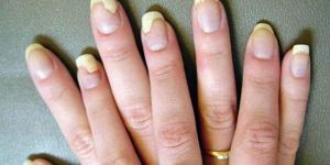 Nail Infection Treatment