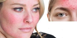 Rosacea Treatment