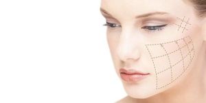 Thread Lift Treatment