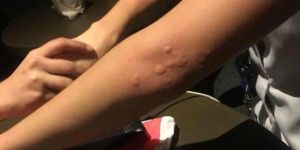 Urticaria Treatment