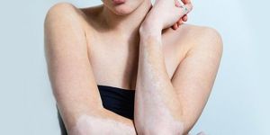 Vitiligo Treatment