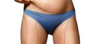 4D Liposuction Surgery