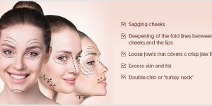 Facelift Surgery