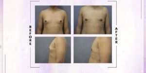 Gynecomastia Surgery