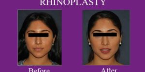 Nose Surgery