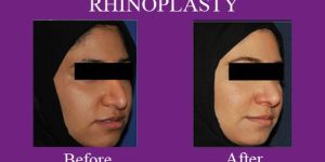 Rhinoplasty Surgery