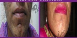 Scar Treatment