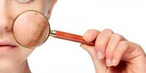 Skin Pigmentation Treatment