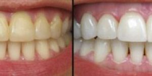 Gum Disease Treatment Services