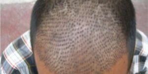 Hair Transplant Services