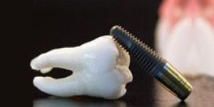Implant Dentistry Treatment Services