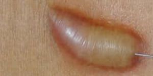 Intralesionalcortisone Injections