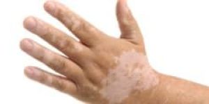 Vitiligo Surgery Treatment Services