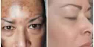 Melasma Treatment