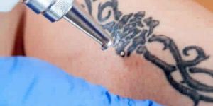 Tattoo Removal Laser