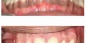 Laser Gum Color Changes