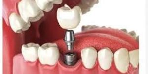 Teeth Replacement Services