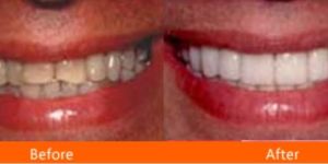 Tooth Colored Fillings Services