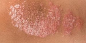 Psoriasis Treatment