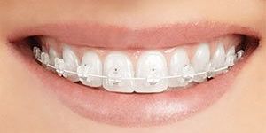 Braces Treatment Services