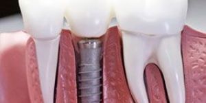 Dental Implant Treatment Services