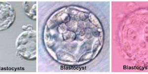 Blastocyst Transfer