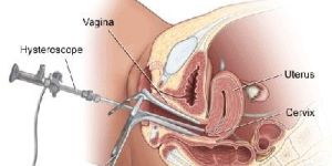 Hysteroscopy Treatment