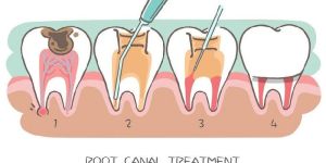 Root Canal Treatment in India