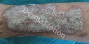 Psoriasis Treatment