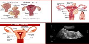 Uterine Fibroids Treatment
