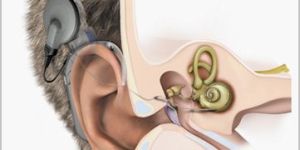 Middle Ear Implant Treatment Services