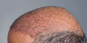 Hair Transplant in Chennai