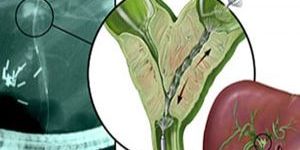 Bile Duct Treatment India