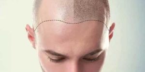 Face Lift Surgery