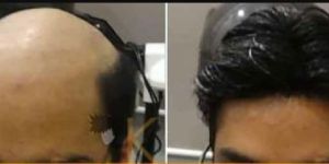 Non-Operative Hair Weaving