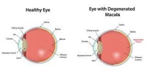 Eyes Macular Degeneration Non-invasive Diagnosis and Therapy