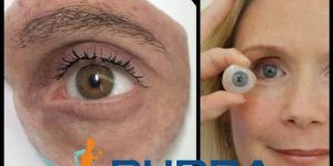 Artificial Eye