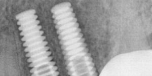 Dental Implant Treatment