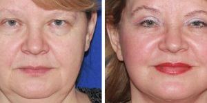 Face Lift Surgery