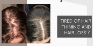 Hair Transplant Service