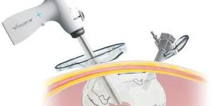 Versator Tissue Morcellator