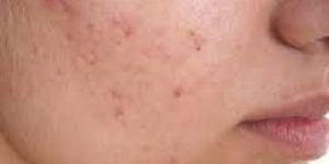 Acne Treatment Services