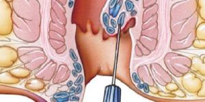 Piles Treatment