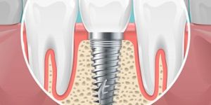 Dental Implant in Kolkata Best Dental Implant in Kolkata Dental Implant Treatment in Kolkata