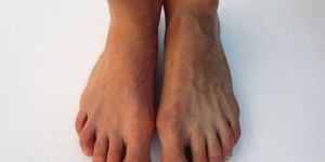 Silicone Foot Prosthesis