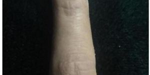 Index Finger Prosthesis