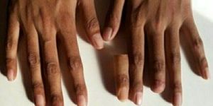 SILICONE FINGER PROSTHESIS