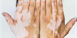 vitiligo treatment services.